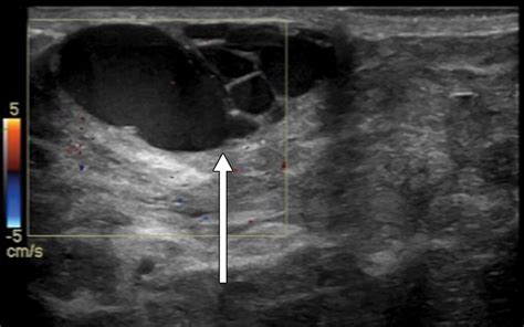 Pediatric and adolescent breast hypertrophy